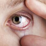 Anatomy of the Eyes -- Eyecites