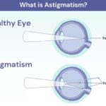 astigmatism and myopia