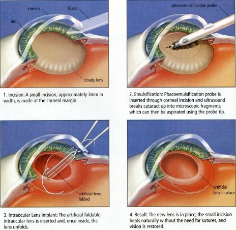 Cataract Surgery and LASIK- Cataract Surgery Procedure