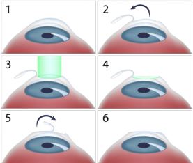 Cataract Surgery and LASIK- LASIK Procedure