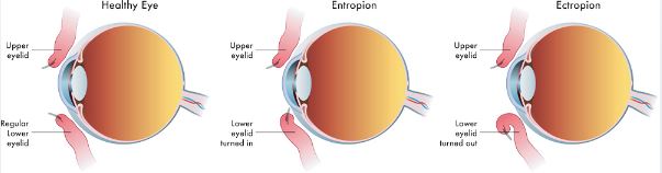 Differences between Ectropion and Entropion