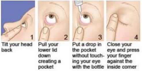 How to instill eyedrops