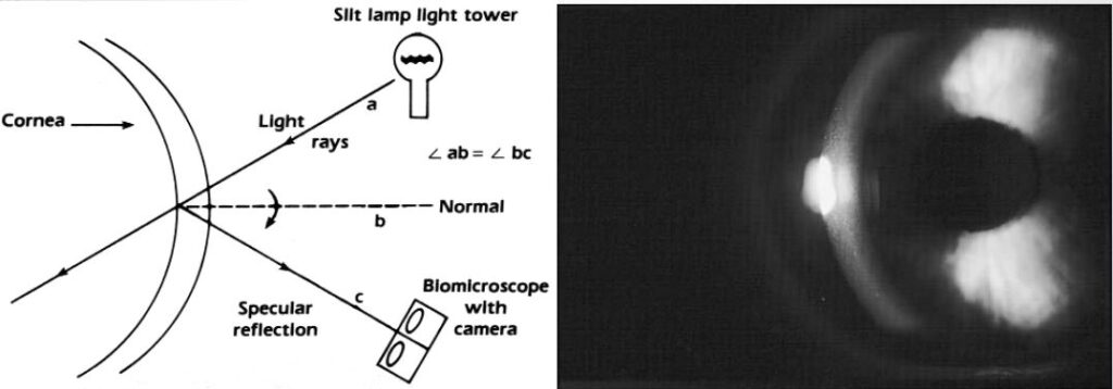 Slit Lamp Illumination Techniques- specular