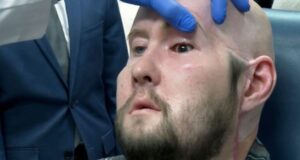 Whole-eye transplant World’s first successful surgery
